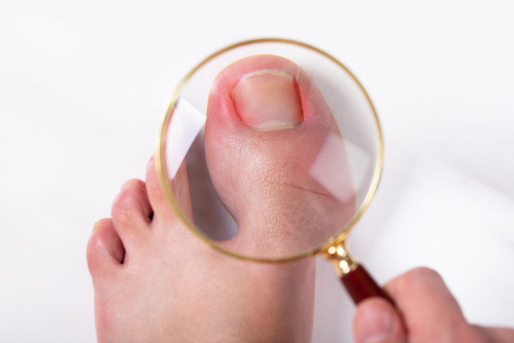 Ingrown Nails